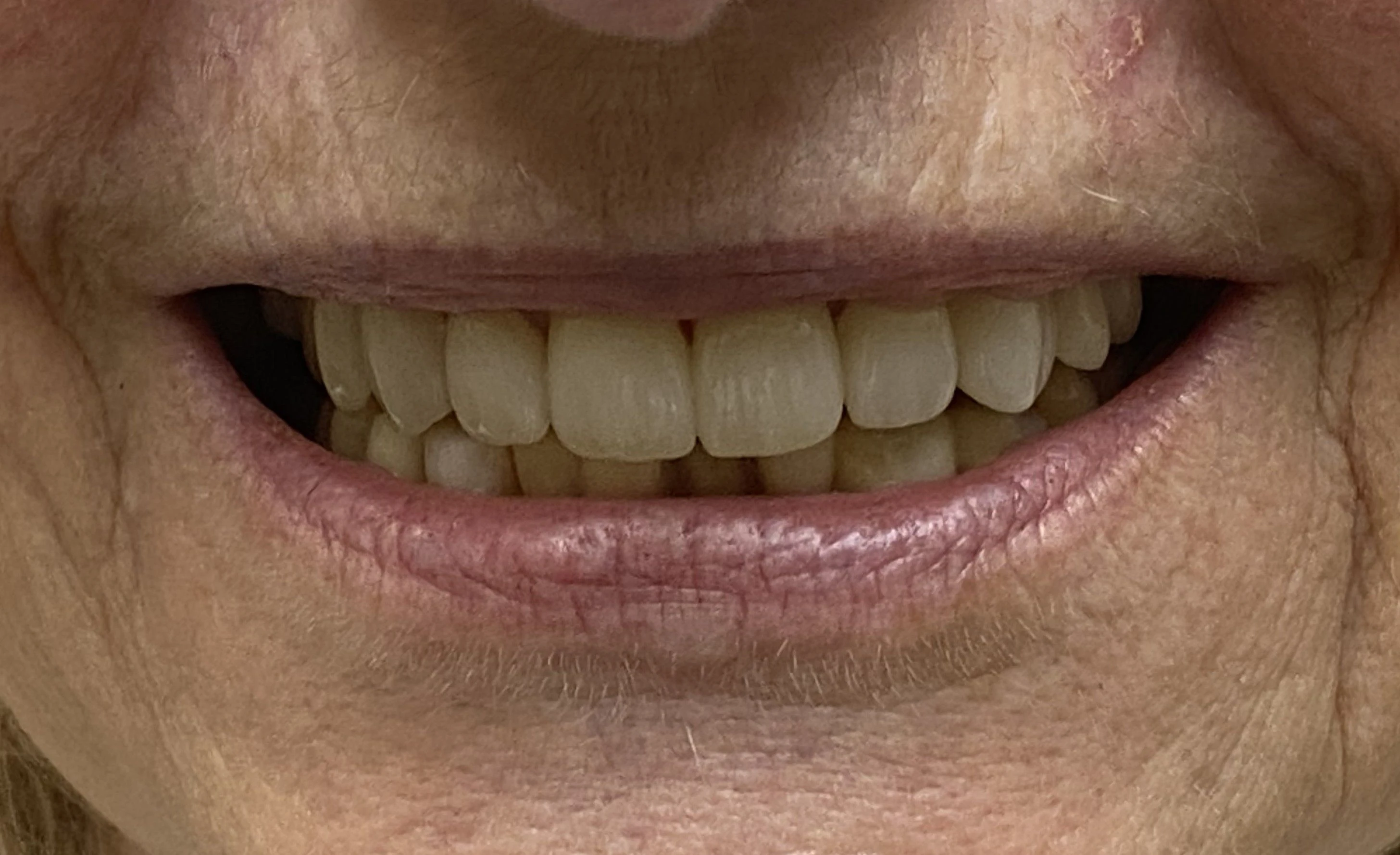 Crown Replacement — After