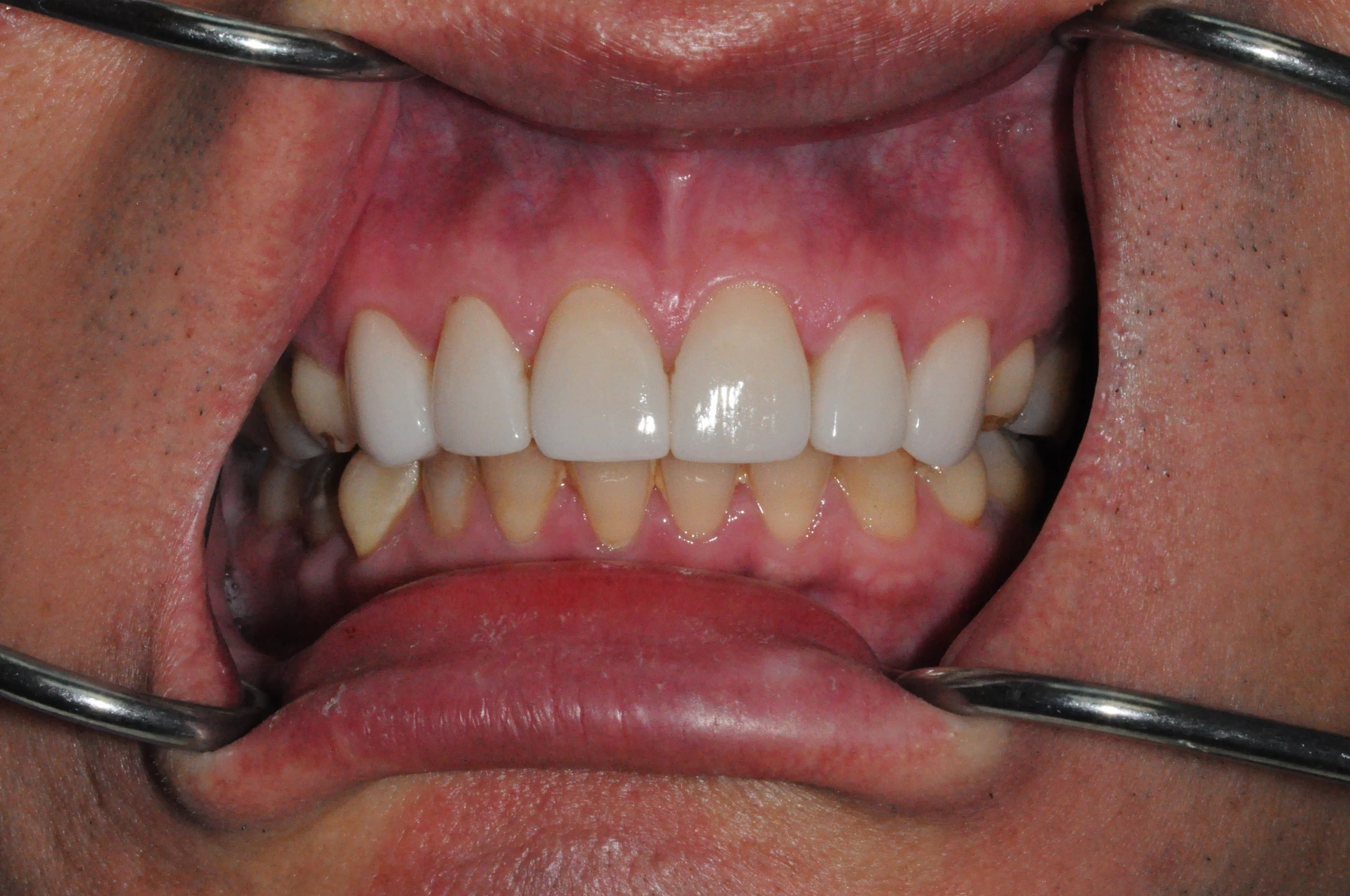 Dental Veneers — After