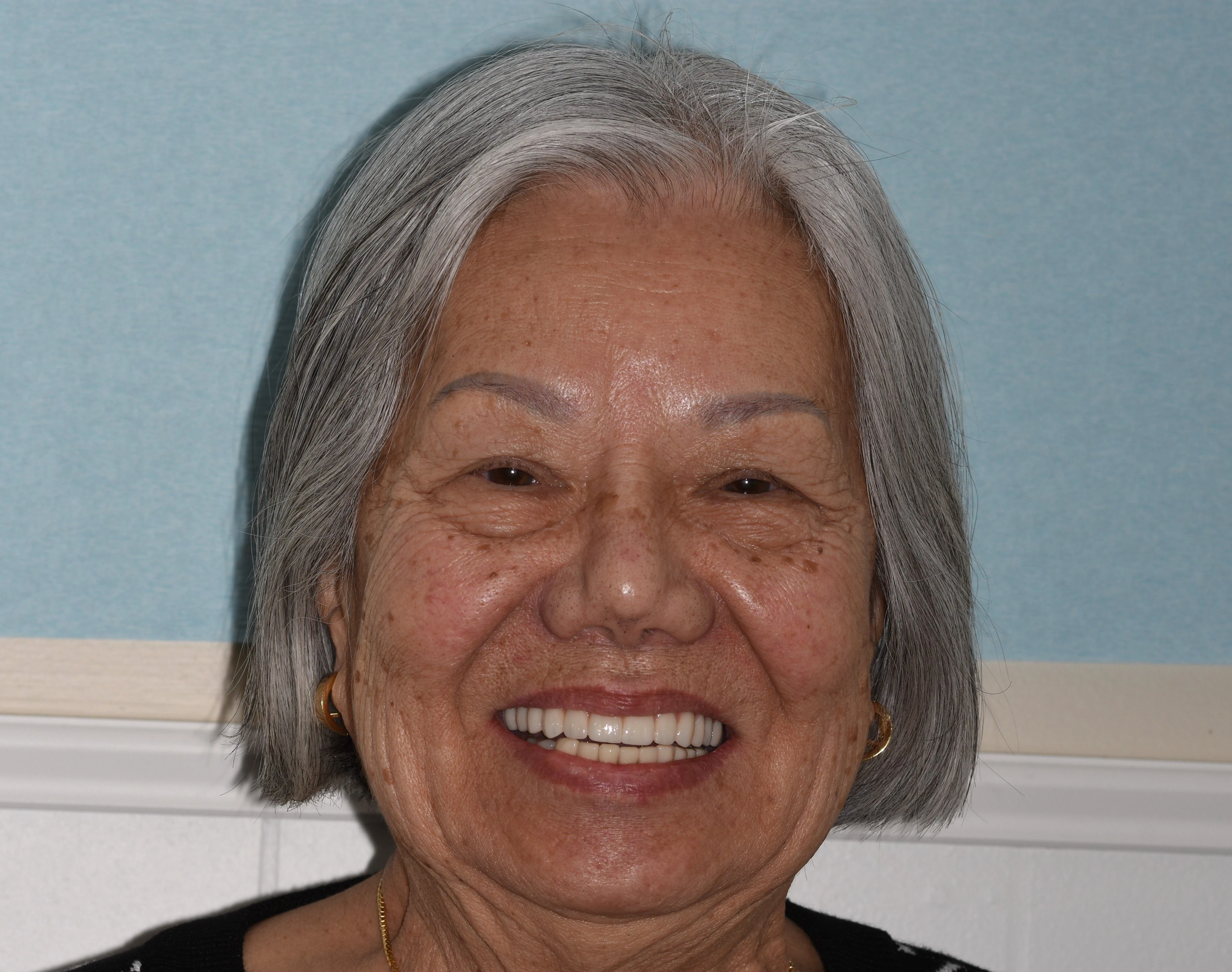 Failing Dental Work — After