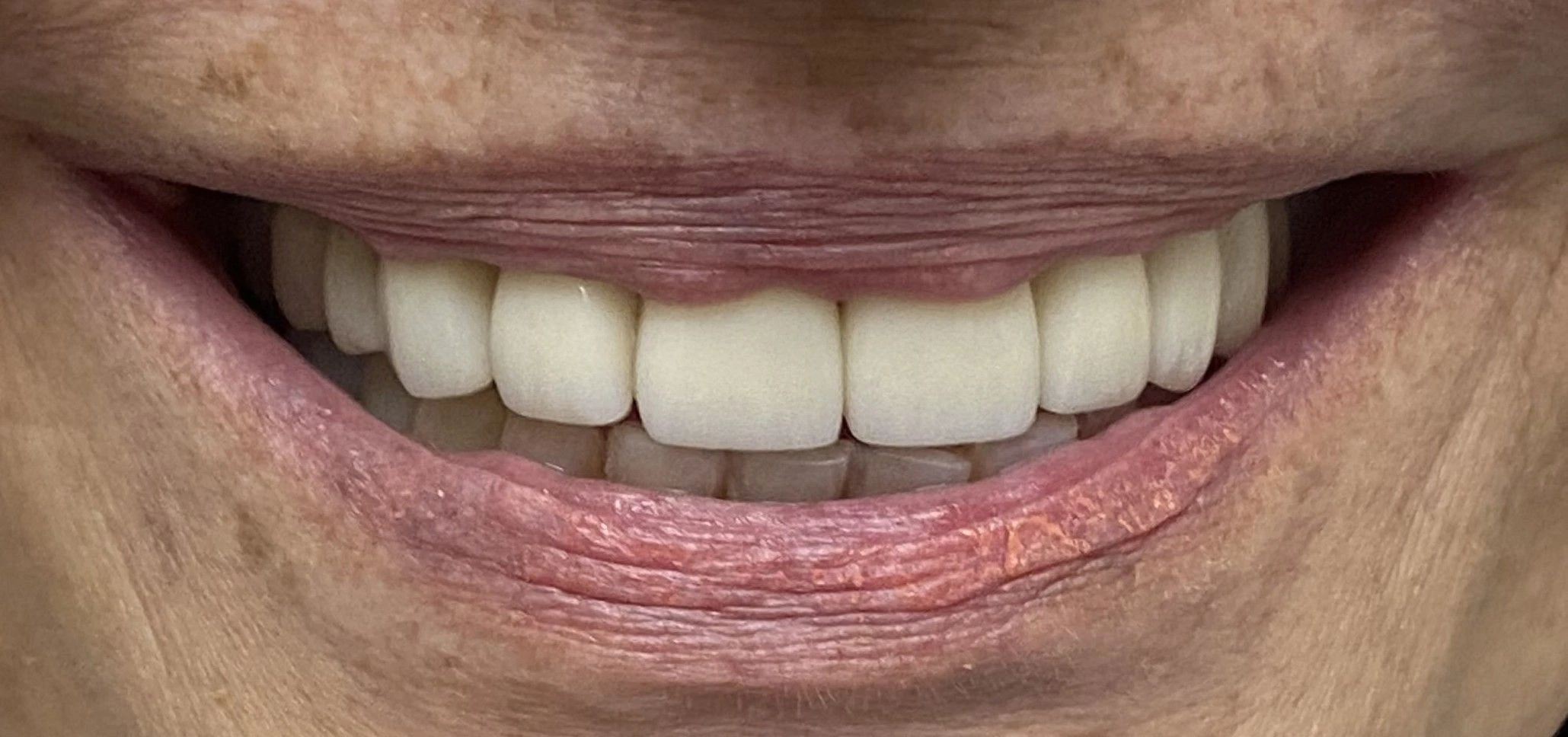 Implant & Crown Restoration — Front Tooth — After