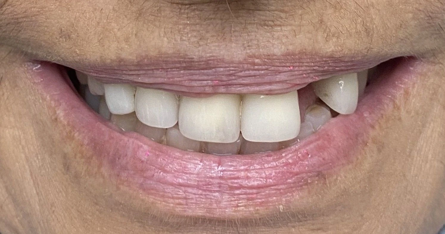 Implant & Crown Restoration — Front Tooth — Before