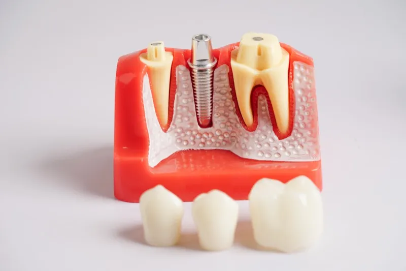 Implant Dentistry